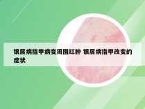 银屑病指甲病变周围红肿 银屑病指甲改变的症状