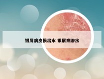 银屑病皮损出水 银屑病渗水