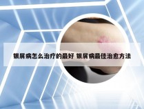 银屑病怎么治疗的最好 银屑病最佳治愈方法