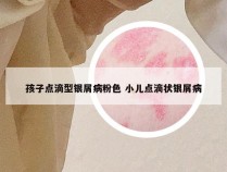 孩子点滴型银屑病粉色 小儿点滴状银屑病