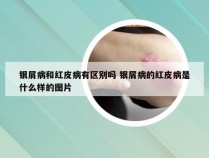 银屑病和红皮病有区别吗 银屑病的红皮病是什么样的图片