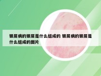银屑病的银屑是什么组成的 银屑病的银屑是什么组成的图片