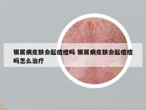 银屑病皮肤会起痘痘吗 银屑病皮肤会起痘痘吗怎么治疗