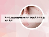为什么银屑病有红的和白的 银屑病为什么连成片变红
