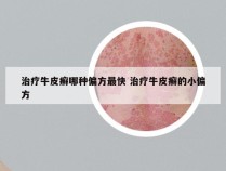 治疗牛皮癣哪种偏方最快 治疗牛皮癣的小偏方