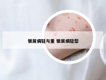 银屑病轻与重 银屑病轻型