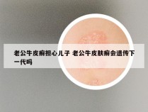 老公牛皮癣担心儿子 老公牛皮肤癣会遗传下一代吗