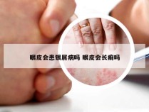 眼皮会患银屑病吗 眼皮会长癣吗