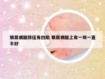 银屑病腿按压有凹陷 银屑病腿上有一块一直不好