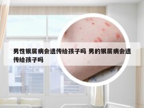 男性银屑病会遗传给孩子吗 男的银屑病会遗传给孩子吗