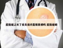 屁股缝上长了皮炎请问是银屑病吗 屁股缝癣