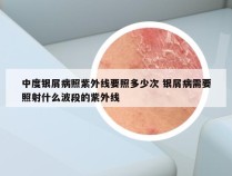 中度银屑病照紫外线要照多少次 银屑病需要照射什么波段的紫外线