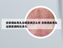 皮肤病血毒丸治银屑病怎么佯 皮肤病血毒丸治银屑病吗吃多久