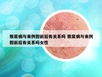 银屑病与来例假前后有关系吗 银屑病与来例假前后有关系吗女性