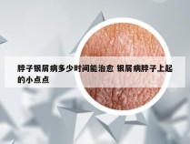 脖子银屑病多少时间能治愈 银屑病脖子上起的小点点