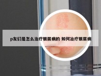 p友们是怎么治疗银屑病的 如何冶疗银屑病
