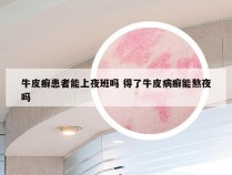 牛皮癣患者能上夜班吗 得了牛皮病癣能熬夜吗