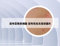 尿布型银屑病图 尿布性皮炎症状图片