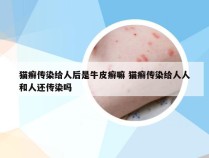 猫癣传染给人后是牛皮癣嘛 猫癣传染给人人和人还传染吗