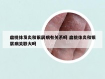 扁桃体发炎和银屑病有关系吗 扁桃体炎和银屑病关联大吗