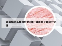 银屑病怎么样治疗比较好 银屑病正确治疗方法