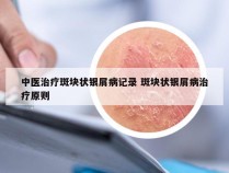 中医治疗斑块状银屑病记录 斑块状银屑病治疗原则
