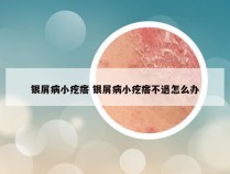 银屑病小疙瘩 银屑病小疙瘩不退怎么办