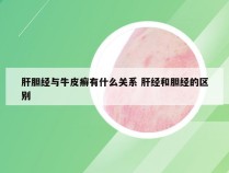 肝胆经与牛皮癣有什么关系 肝经和胆经的区别