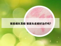 银屑病头发癣 银屑头皮癣好治疗吗?