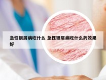 急性银屑病吃什么 急性银屑病吃什么药效果好
