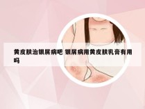黄皮肤治银屑病吧 银屑病用黄皮肤乳膏有用吗
