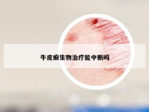 牛皮癣生物治疗能中断吗