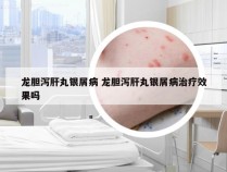 龙胆泻肝丸银屑病 龙胆泻肝丸银屑病治疗效果吗