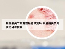银屑病关节炎变性后能恢复吗 银屑病关节炎变形可以恢复
