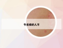 牛皮癣的人不