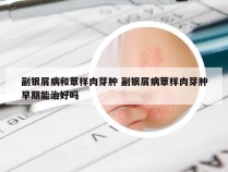 副银屑病和蕈样肉芽肿 副银屑病蕈样肉芽肿早期能治好吗
