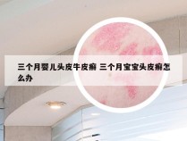 三个月婴儿头皮牛皮癣 三个月宝宝头皮癣怎么办