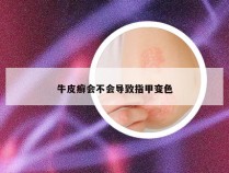 牛皮癣会不会导致指甲变色