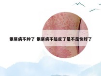 银屑病不肿了 银屑病不起皮了是不是快好了