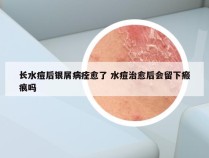 长水痘后银屑病痊愈了 水痘治愈后会留下瘢痕吗