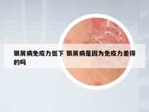 银屑病免疫力低下 银屑病是因为免疫力差得的吗