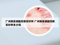 广州银屑病医院那家好啊 广州银屑病医院那家好啊多少钱