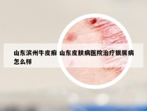 山东滨州牛皮癣 山东皮肤病医院治疗银屑病怎么样