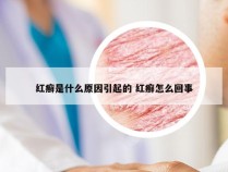 红癣是什么原因引起的 红癣怎么回事