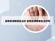 副银屑病哪里能治好 副银屑病哪里能治好呢