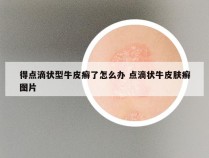 得点滴状型牛皮癣了怎么办 点滴状牛皮肤癣图片