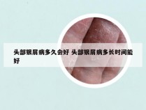 头部银屑病多久会好 头部银屑病多长时间能好