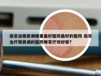 南京治银屑病哪里最好医院最好的医院 南京治疗银屑病的医院哪家疗效好些?