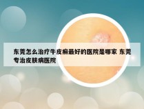 东莞怎么治疗牛皮癣最好的医院是哪家 东莞专治皮肤病医院