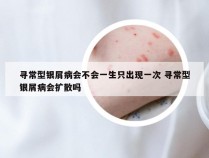 寻常型银屑病会不会一生只出现一次 寻常型银屑病会扩散吗